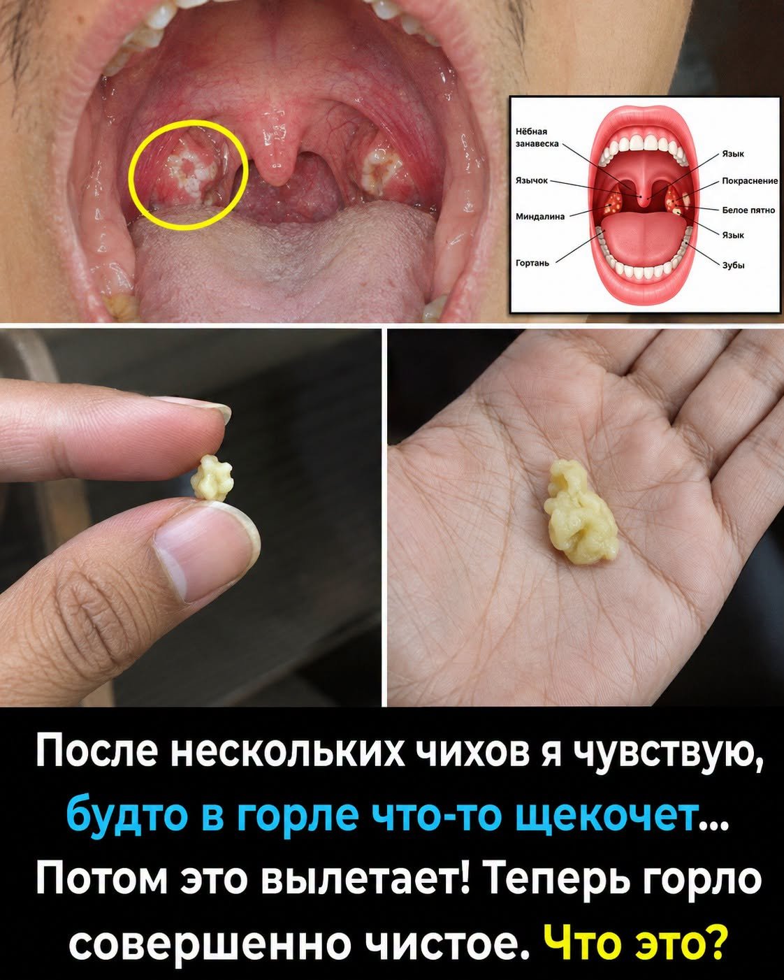 Неприятный запах изо рта не проходит? Причина может быть у вас прямо в миндалинах